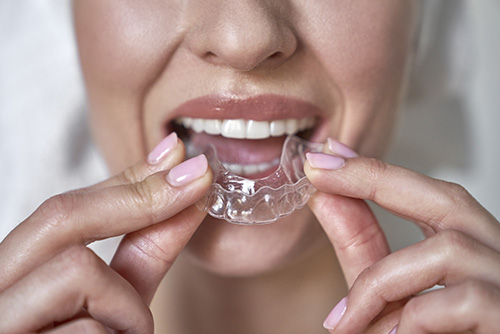 Clear Aligners