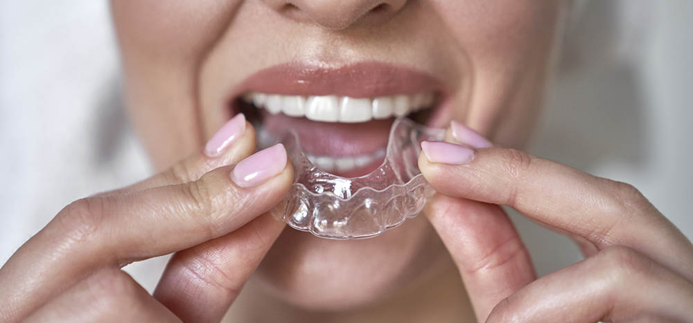 Clear Aligners