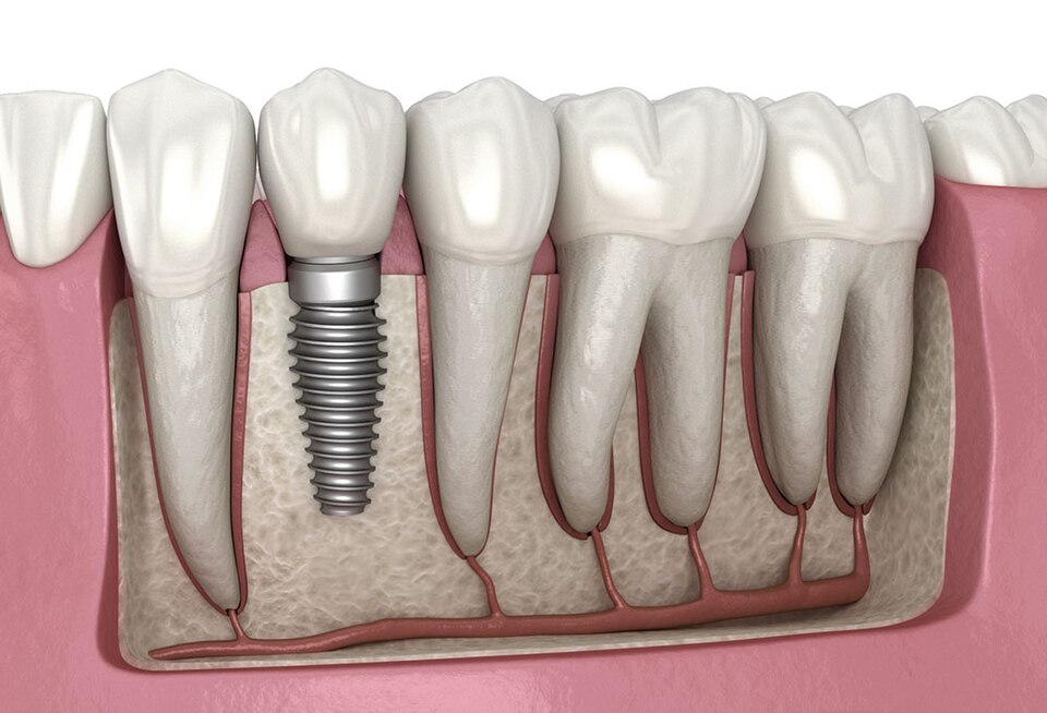 You are currently viewing Understanding 3D Dental Implants: Technology & Cost in Hyderabad