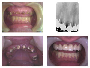 Read more about the article Smile Makeover: Complete Smile Design & Cost in Hyderabad