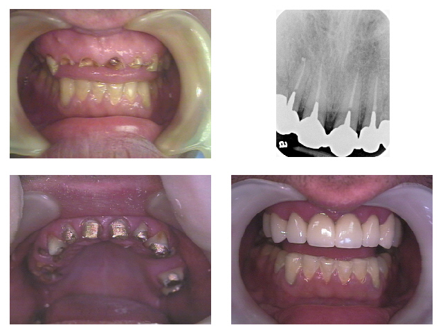 You are currently viewing Smile Makeover: Complete Smile Design & Cost in Hyderabad