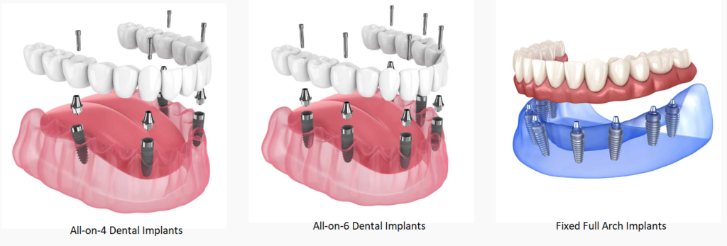 All-on-4 Dental Implants in Hyderabad: Cost, Procedure & Benefits