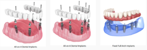 Read more about the article All-on-4 Dental Implants in Hyderabad: Cost, Procedure & Benefits
