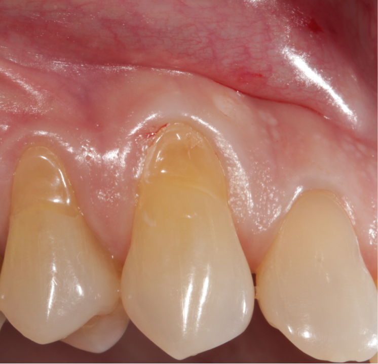 Receding Gums: Causes, Warning Signs and Treatment
